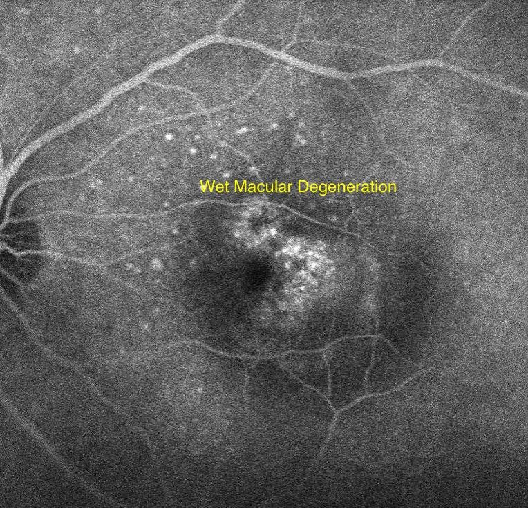 wet Macular Degeneration Image