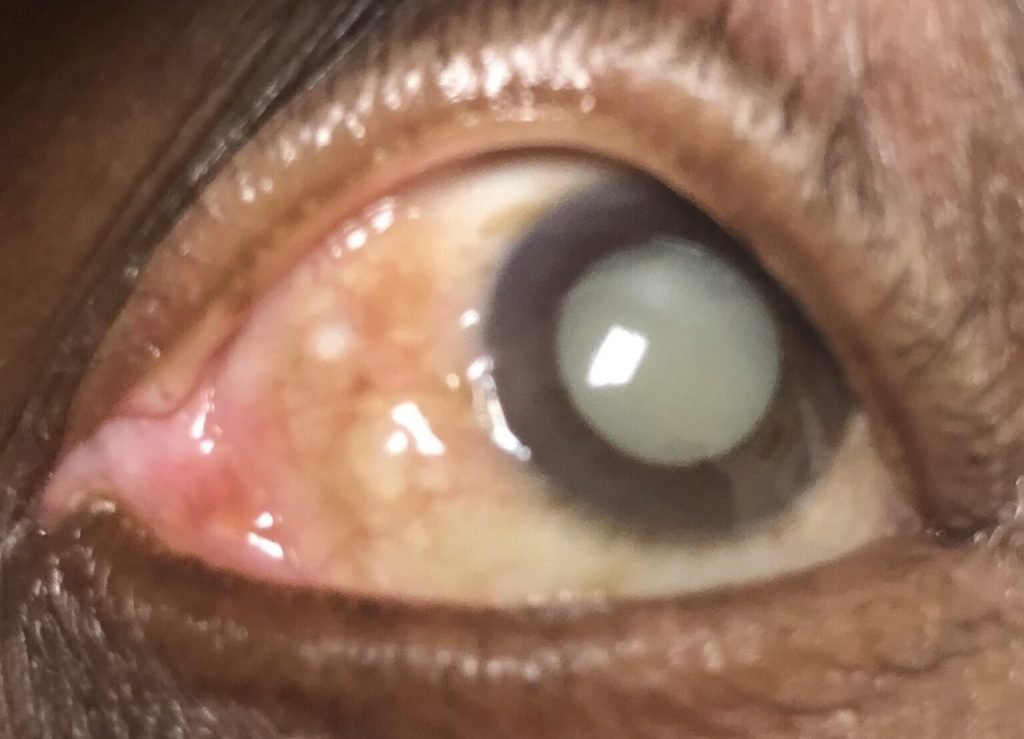 Cataracts View