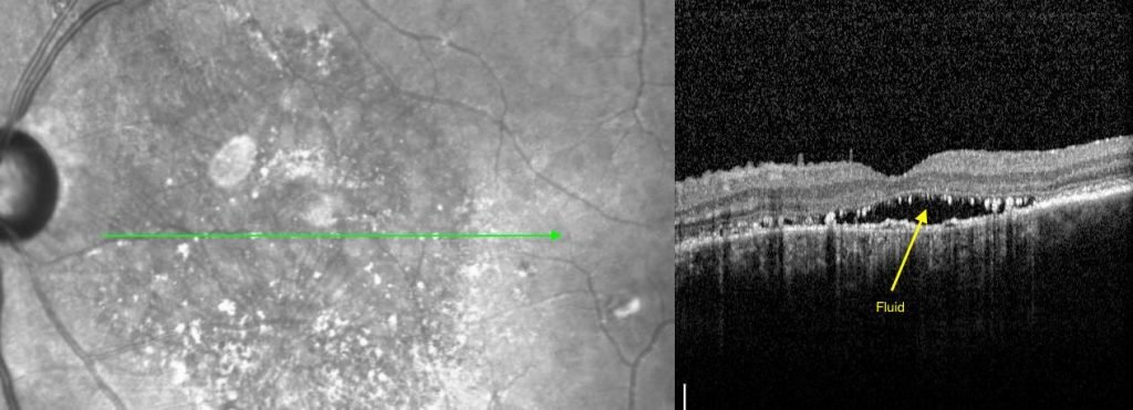 Central-serous-retinopathy treatment Tx