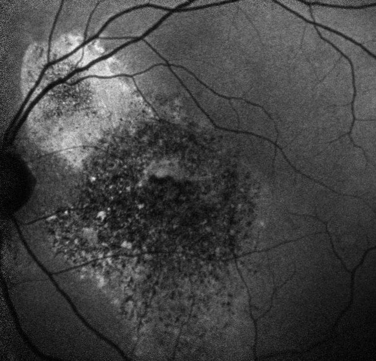 Central-serous-retinopathy Treatment Texas