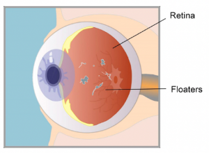 Retina & floaters Image