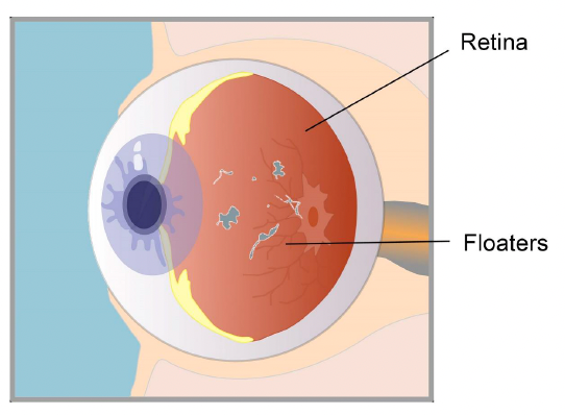 Retina & floaters Image