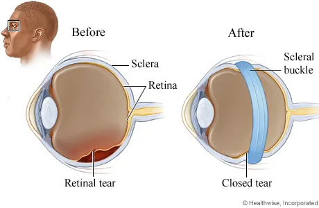 Scleral-Buckle 2