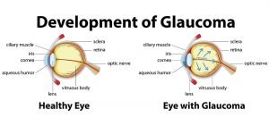 Development of Glaucoma Image
