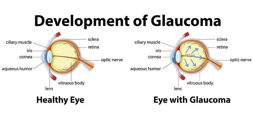 Development of Glaucoma Image