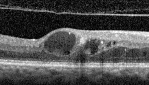 cystoid-macular-edema image