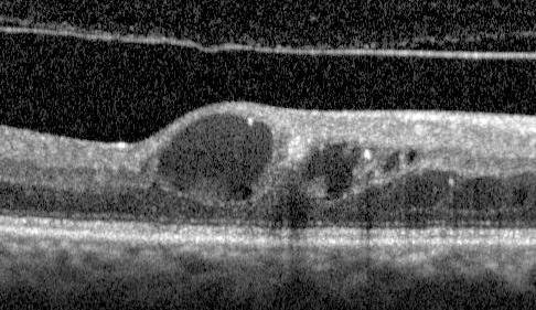 cystoid-macular-edema image