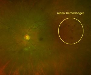 diabetic-retinopathy Hemorrhages