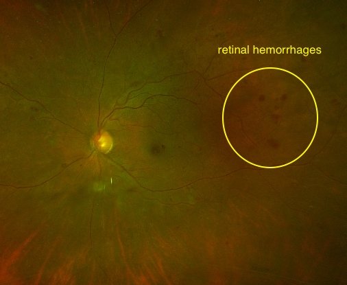 diabetic-retinopathy Hemorrhages