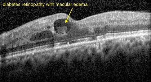diabetic-retinopathy Macular Edema
