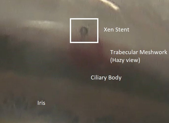Incisional Surgeries texas