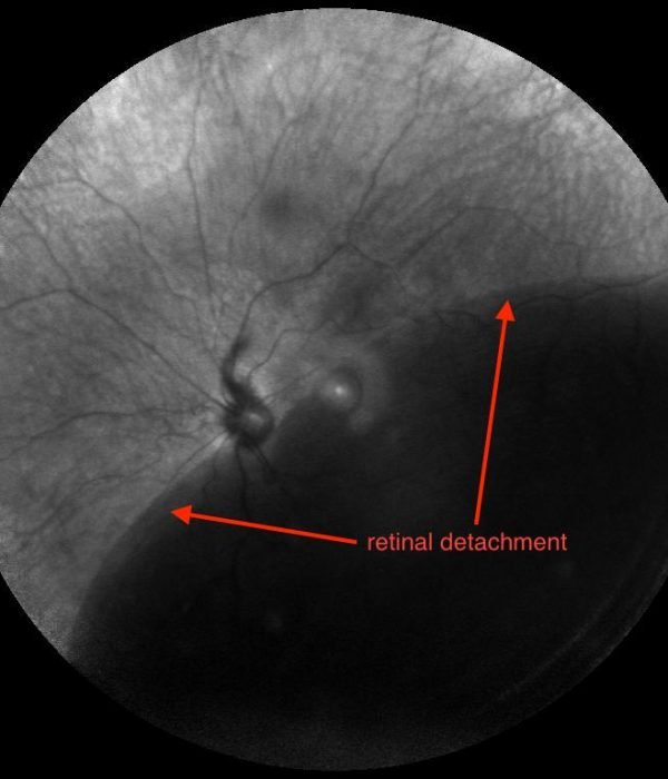 retinal-detachment Explanation