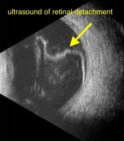 Ultrasound Retinal Detachment Texas