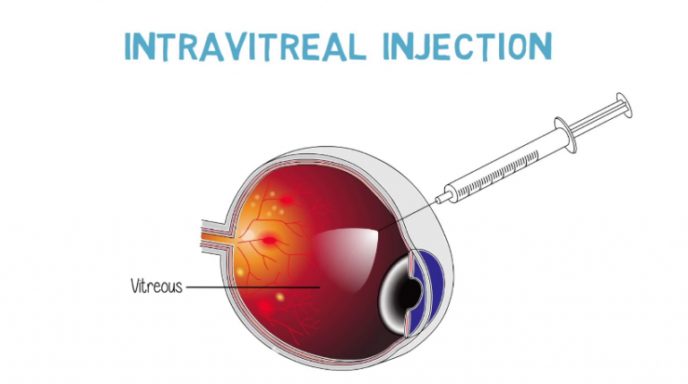 Intravitreal Injection Sherman Tx