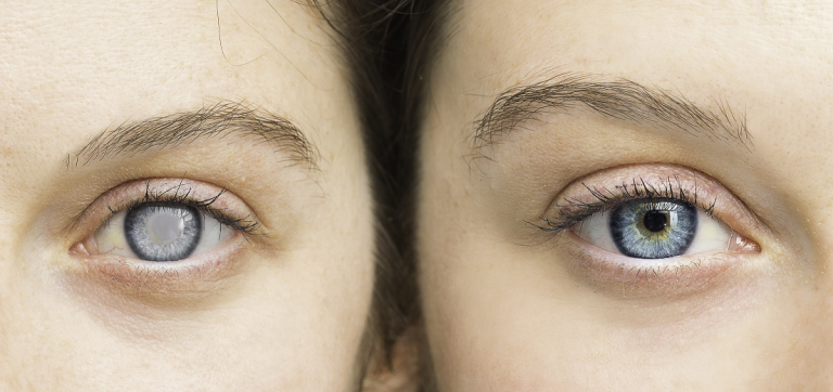 Glaucoma Image of a women