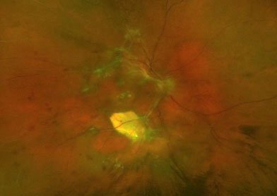 Diabetic Retinopathy Sherman Tx