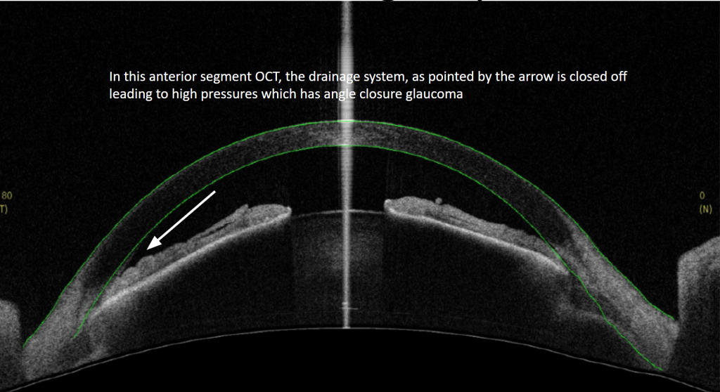 Glaucoma subtypes ASOCT