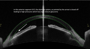 Glaucoma subtypes ASOCT