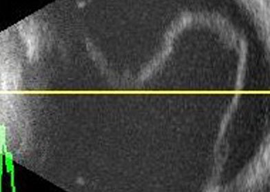 Retinal Tears and Detachments Treatment