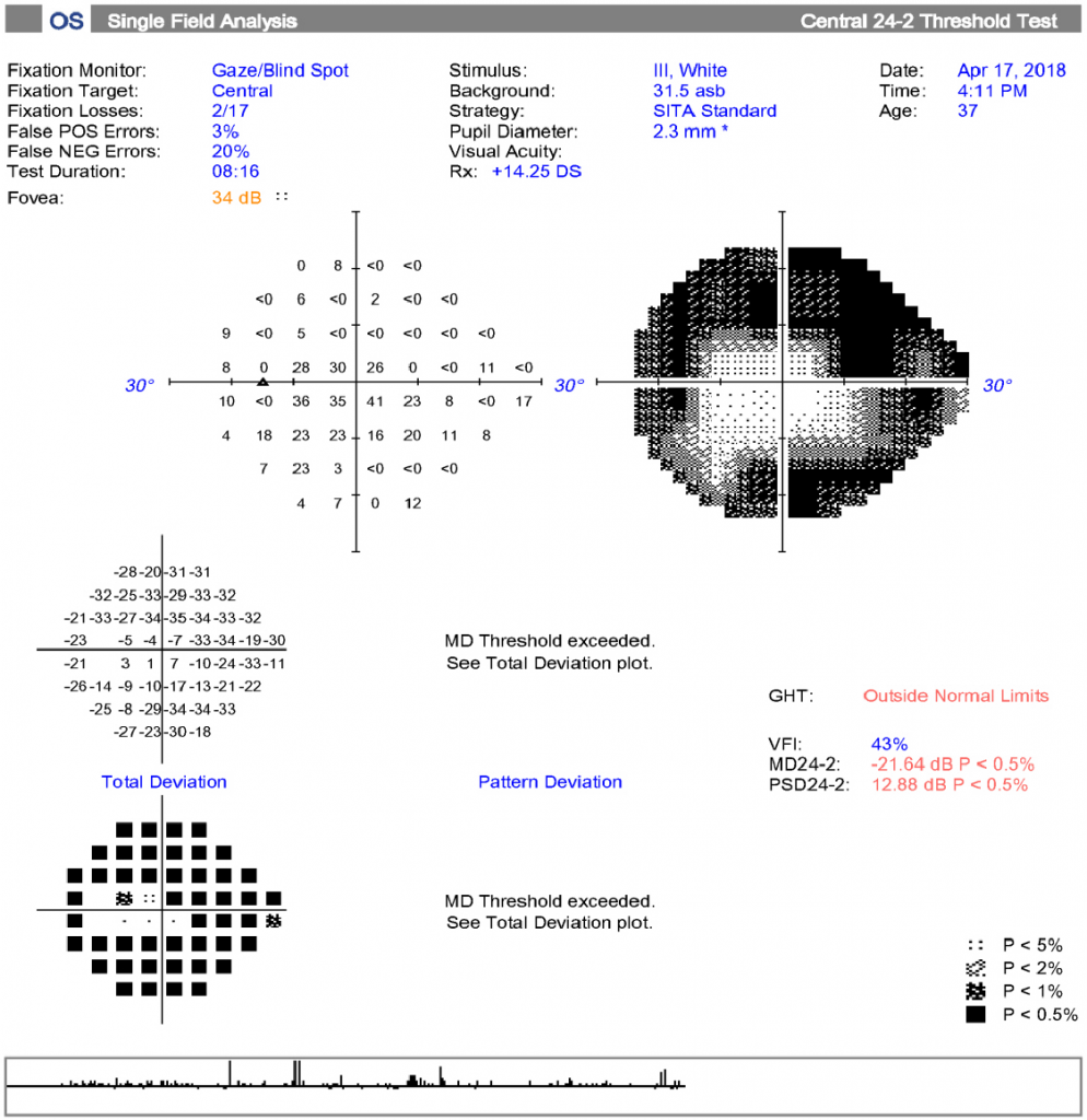 Glaucoma Treatment in Texas