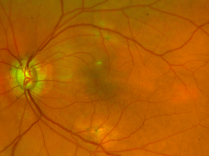 Glaucoma Optic Nerve View