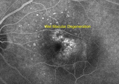 Wet Macular Degeneration Treatment