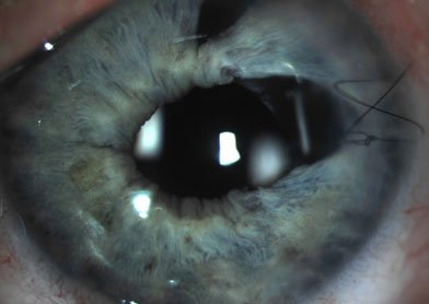 Glaucoma Eye De treatment McKinney TX