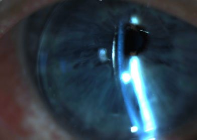 Glaucoma eye treatment Texas