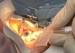 Lens Implant Sherman Tx