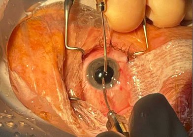 lens implant Treatment Allen Tx