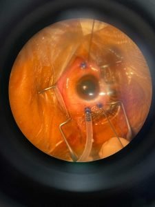 scleral buckle treatment Sherman Tx