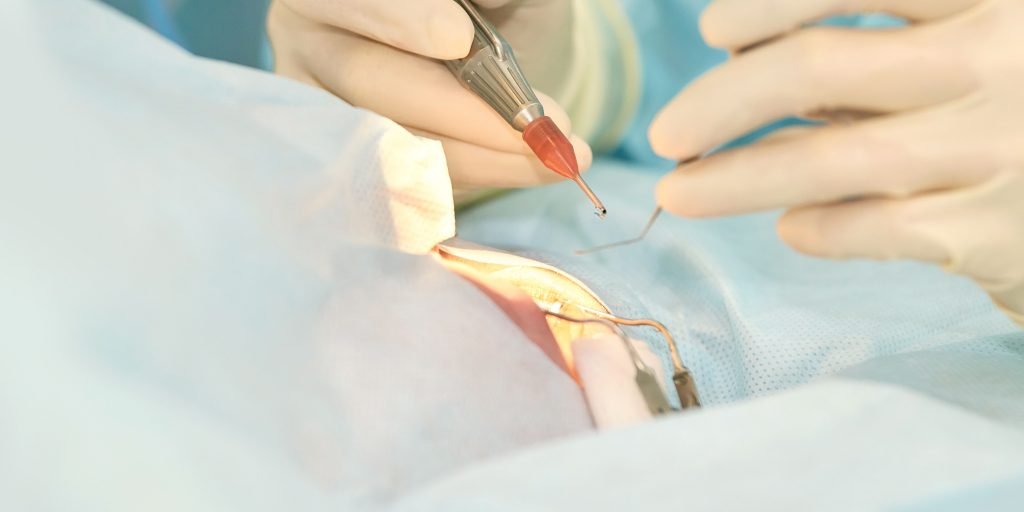 Cataract Removal Surgery