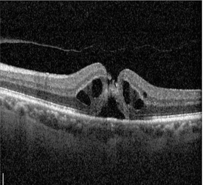 Macular Hole Vitrectomy