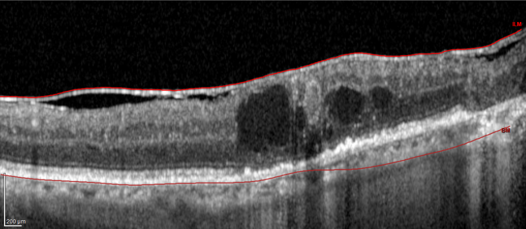 Epiretinal Membrane Vitrectomy