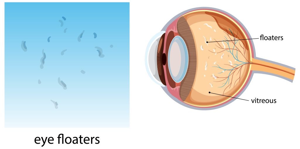 Eye Floaters Treatment in Texas