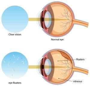 What Causes Eye Floaters? Know More About It !