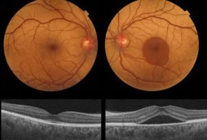 Central Serous Rethinopathy treatment Texas