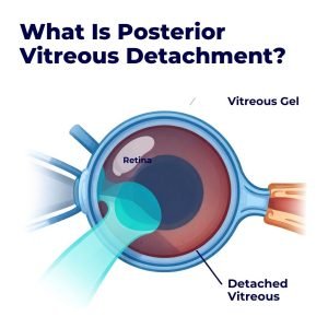Posterior Vitreous Detachment in Texas