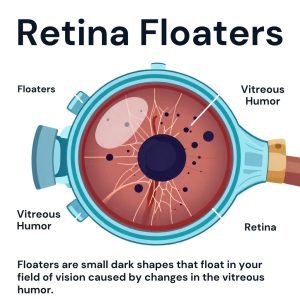 Retinal Floaters Trestment n Texas