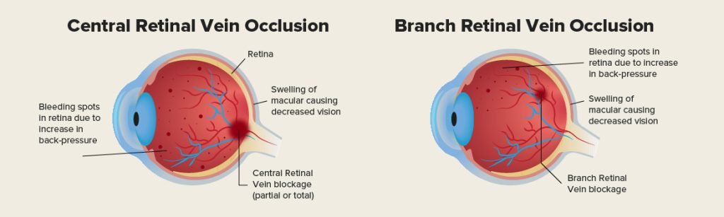 Vein Occlusion explanation