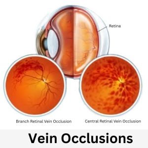 Vein Occlusion Treatment in Texas
