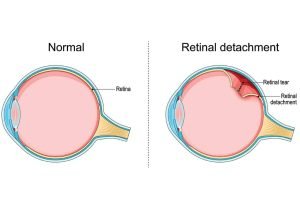 Retinal Tear and Detachement in Texas