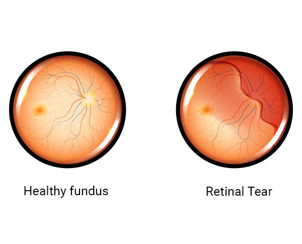 Retina Tear Image