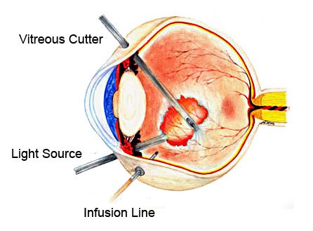 Endophthalmitis Vitrectomy Treatment in Texas