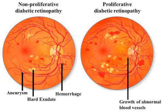 Proliferative Diabetic Retinopathy Treatmentin Texas