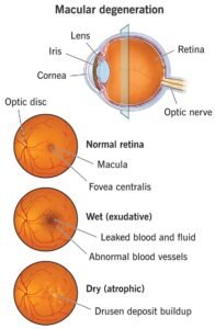 Breakthroughs and New Treatments for Macular Degeneration