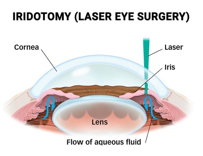 Laser Peripheral Iridotomy Treatment in Texas