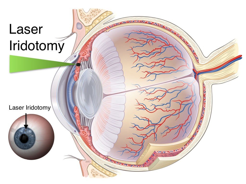 Laser Peripheral Iridotomy Surgery Texas