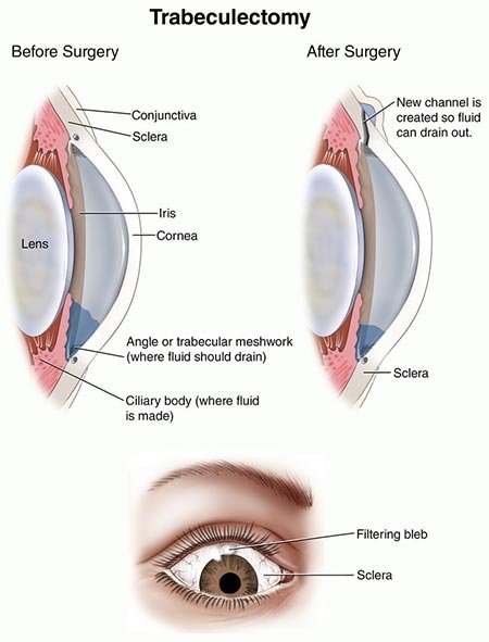Trabeculectomy Surgery in North Texas