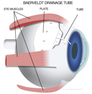 Glaucoma Tube Shunt Surgery in texas